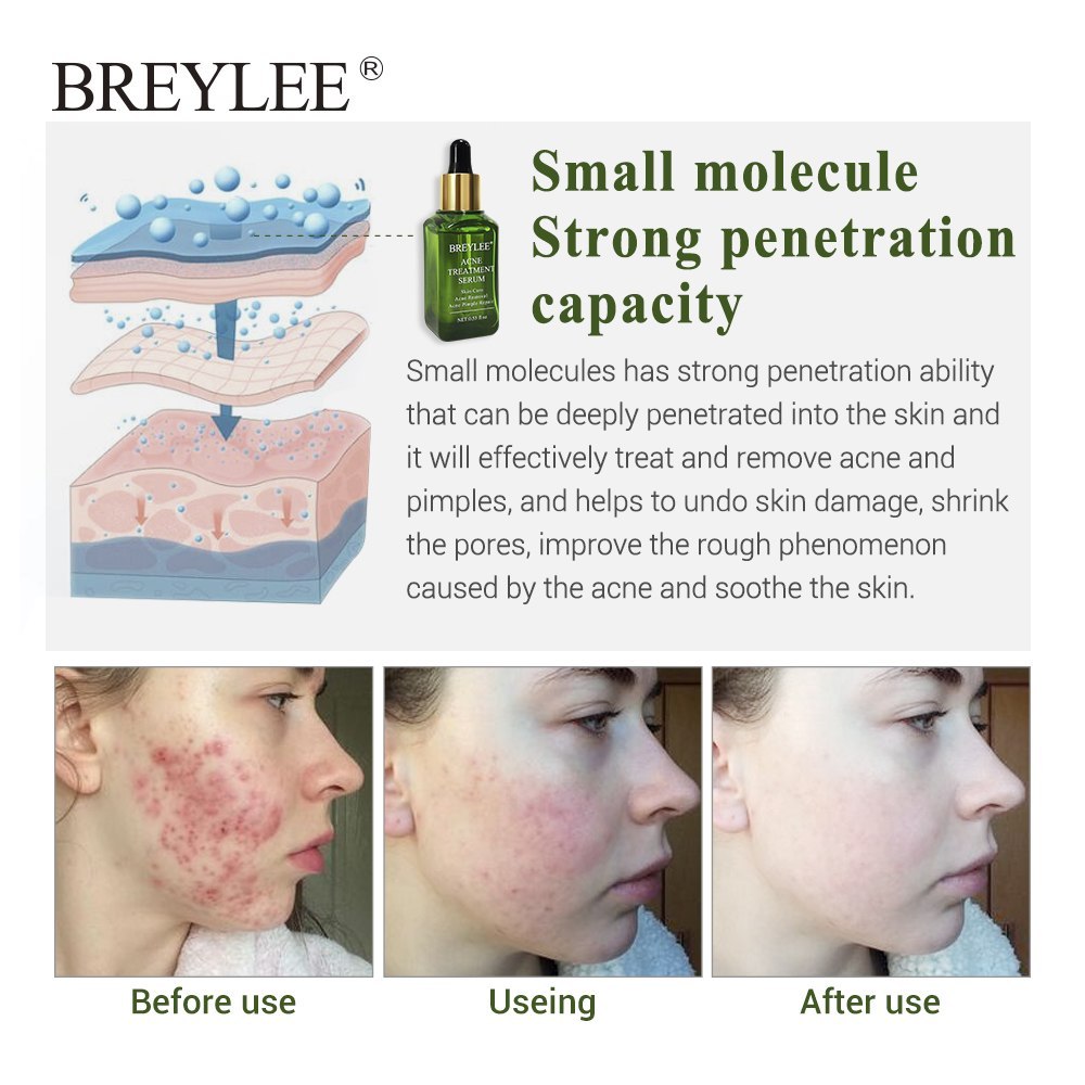 BREYLEE Acne Treatment Serum Face Facial Anti Acne Scar Removal Cream Skin Care Whitening Repair Pimple Remover For Acne - Lootquake
