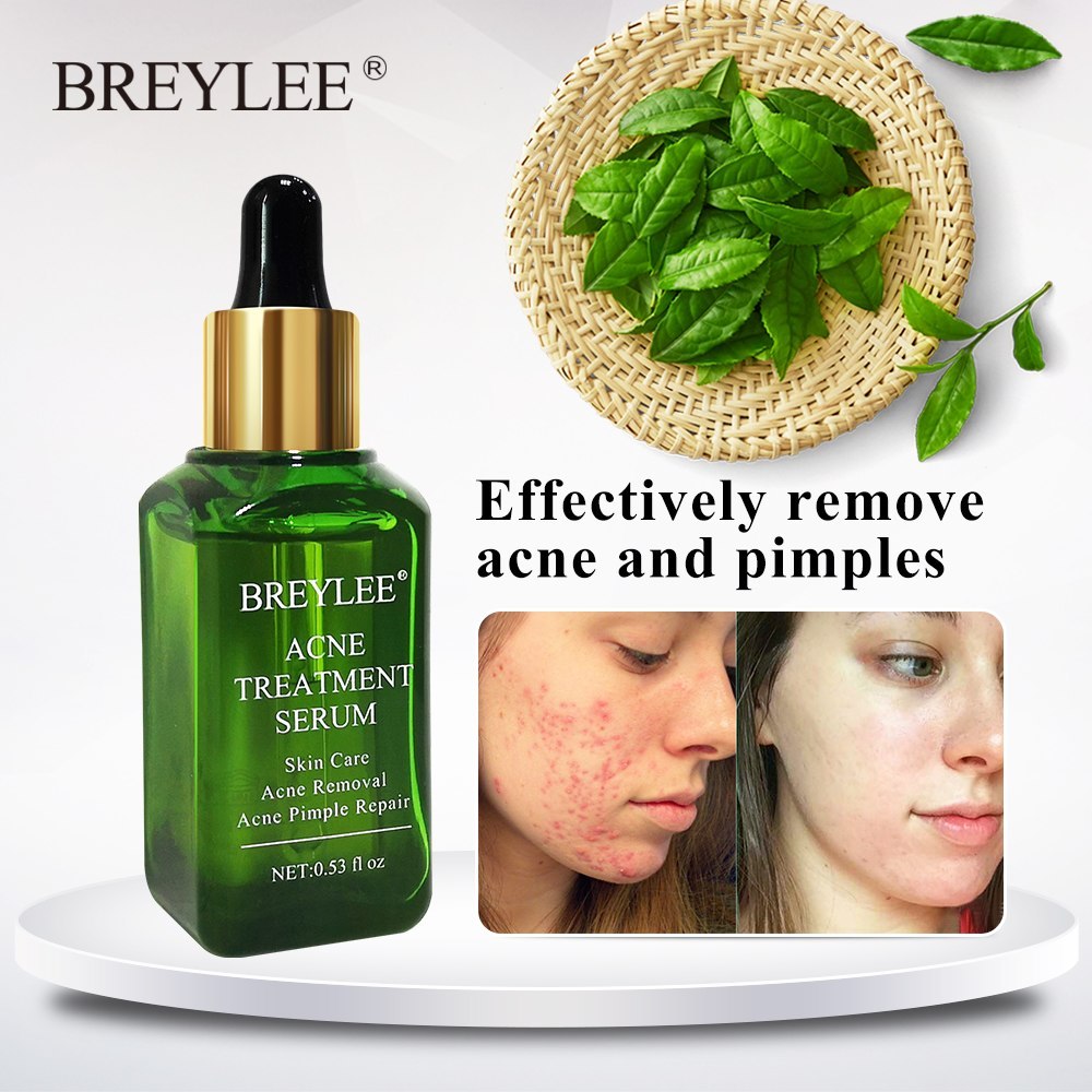 BREYLEE Acne Treatment Serum Face Facial Anti Acne Scar Removal Cream Skin Care Whitening Repair Pimple Remover For Acne - Lootquake