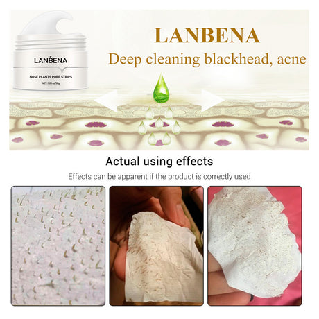 Blackhead Nasal Membrane Sucking Blackhead Tearing To Remove Acne - Lootquake