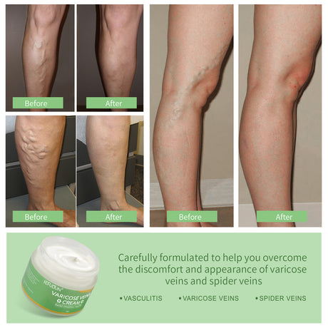 Vein Cream Red Blood Streaks Repair Earthworm Leg Bruises Bulge Relief Pain Safflower Skin care lotion Varicose Cream - Lootquake