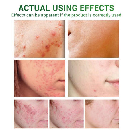 Acne Treatment Serum Facial Repair Oil - Lootquake