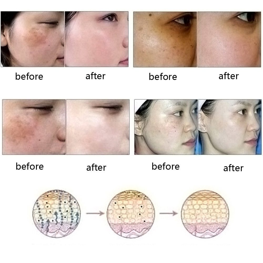 Dredge Meridian Skin Care Natural Pure Removal Acne Stretch Marks Scar Removal Essence oil - Lootquake