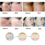 Dredge Meridian Skin Care Natural Pure Removal Acne Stretch Marks Scar Removal Essence oil - Lootquake
