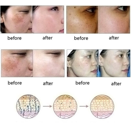 Dredge Meridian Skin Care Natural Pure Removal Acne Stretch Marks Scar Removal Essence oil - Lootquake