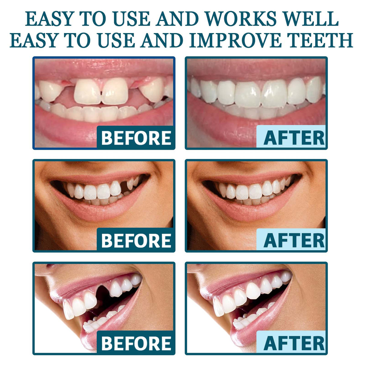 Adjustable Snap-On Dentures: Your Perfect Smile Solution