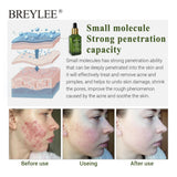 BREYLEE Acne Treatment Serum Face Facial Anti Acne Scar Removal Cream Skin Care Whitening Repair Pimple Remover For Acne - Lootquake