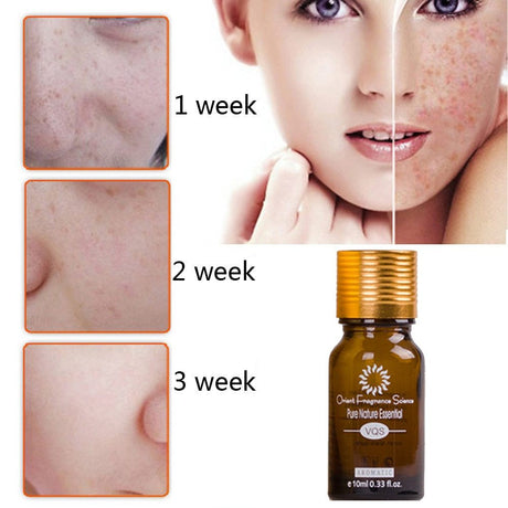 Dredge Meridian Skin Care Natural Pure Removal Acne Stretch Marks Scar Removal Essence oil - Lootquake