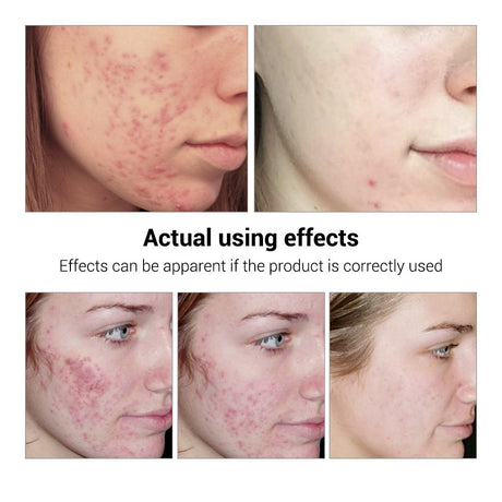 BREYLEE Acne Treatment Serum Face Facial Anti Acne Scar Removal Cream Skin Care Whitening Repair Pimple Remover For Acne - Lootquake