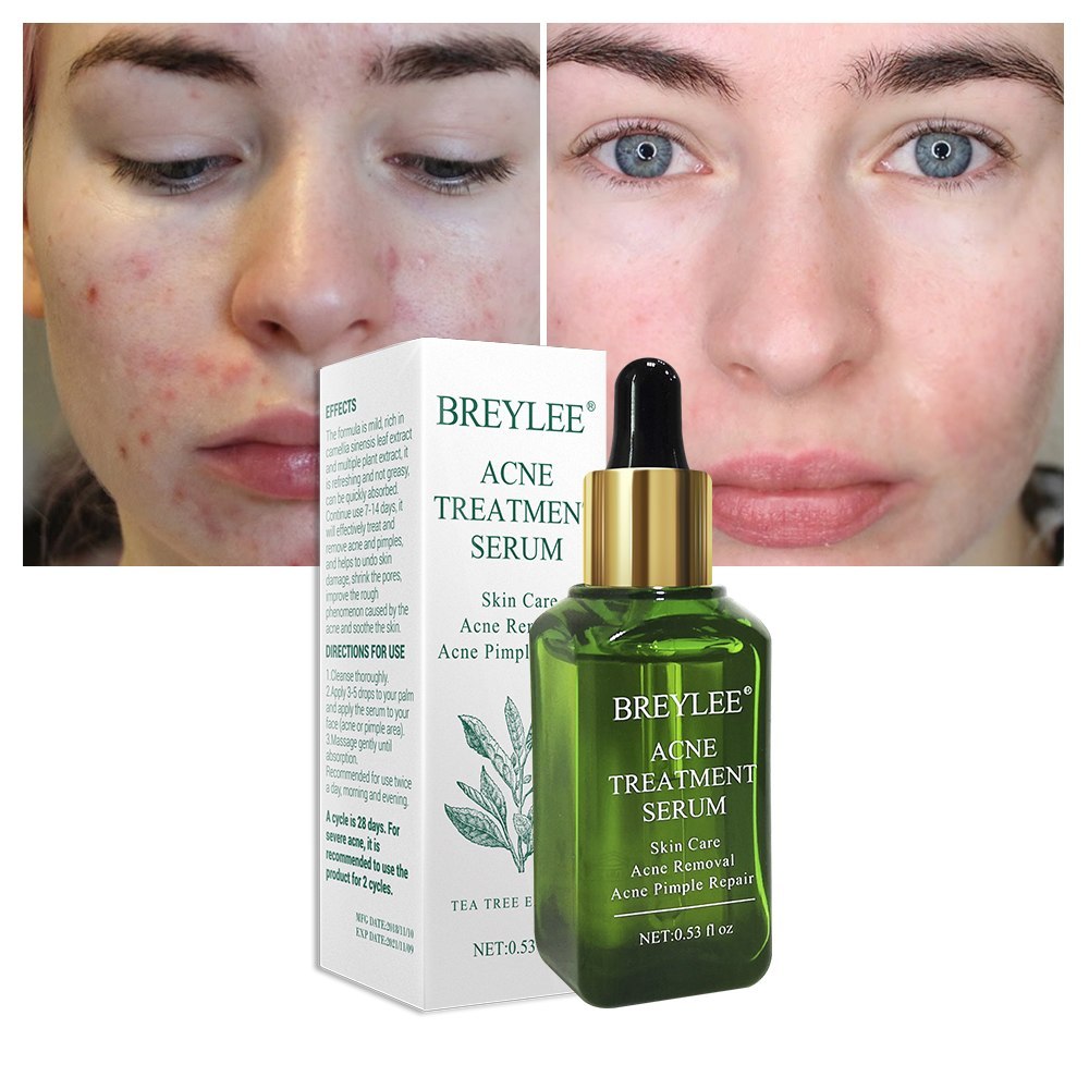 BREYLEE Acne Treatment Serum Face Facial Anti Acne Scar Removal Cream Skin Care Whitening Repair Pimple Remover For Acne - Lootquake