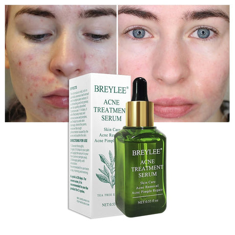 BREYLEE Acne Treatment Serum Face Facial Anti Acne Scar Removal Cream Skin Care Whitening Repair Pimple Remover For Acne - Lootquake