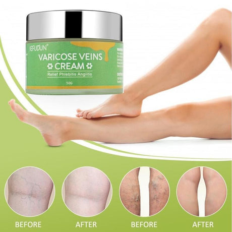 Vein Cream Red Blood Streaks Repair Earthworm Leg Bruises Bulge Relief Pain Safflower Skin care lotion Varicose Cream - Lootquake